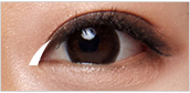 Canthoplasty-4