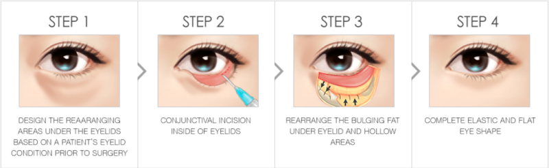 How to get rid of eye bags without the need for surgery - Mirror Online