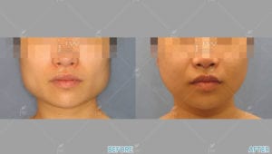 Before After Face Contouring In Korea