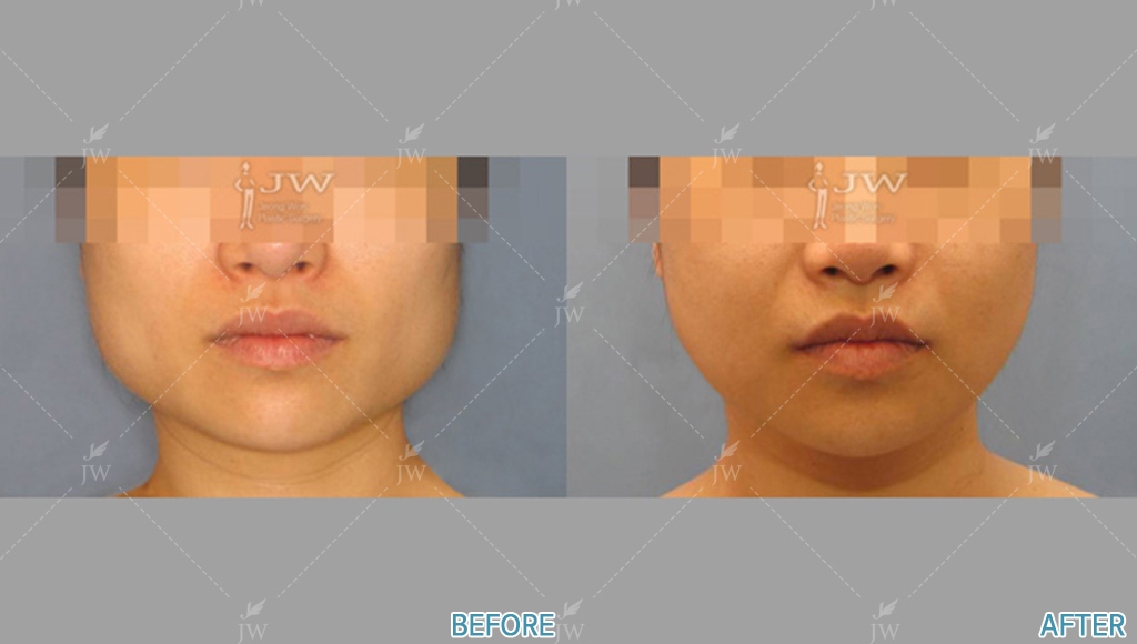 Before After Face Contouring In Korea | JW Clinic
