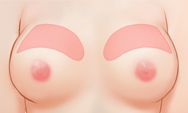 breast4_img1c