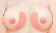 breast4_img1f