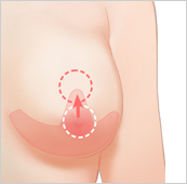 breast5_img4