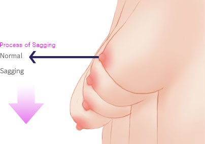 breast6_img2