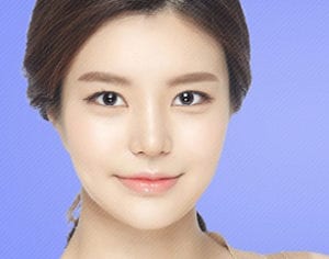 In double facelift, AccuSculpt and thread facelift complement each other and create a synergy effect for facelifts