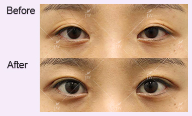eye-revision-surgery-jw-plastic-surgery-clinic-korea-12