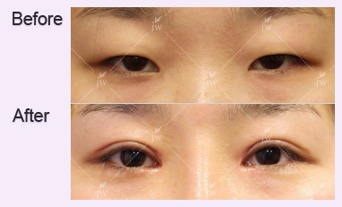 eye-revision-surgery-jw-plastic-surgery-clinic-korea-6
