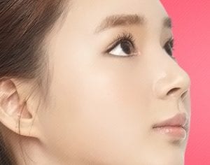 Non-incision Lower Blepharoplasty in korea