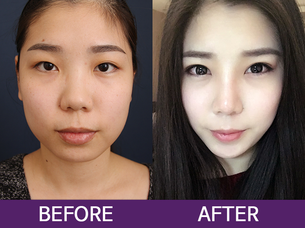 My Plastic Surgery Journey – Part II - JW Plastic Surgery