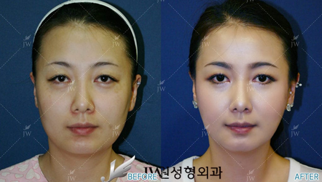Facial Bone Contouring - Cheekbone Reduction, Square Jaw