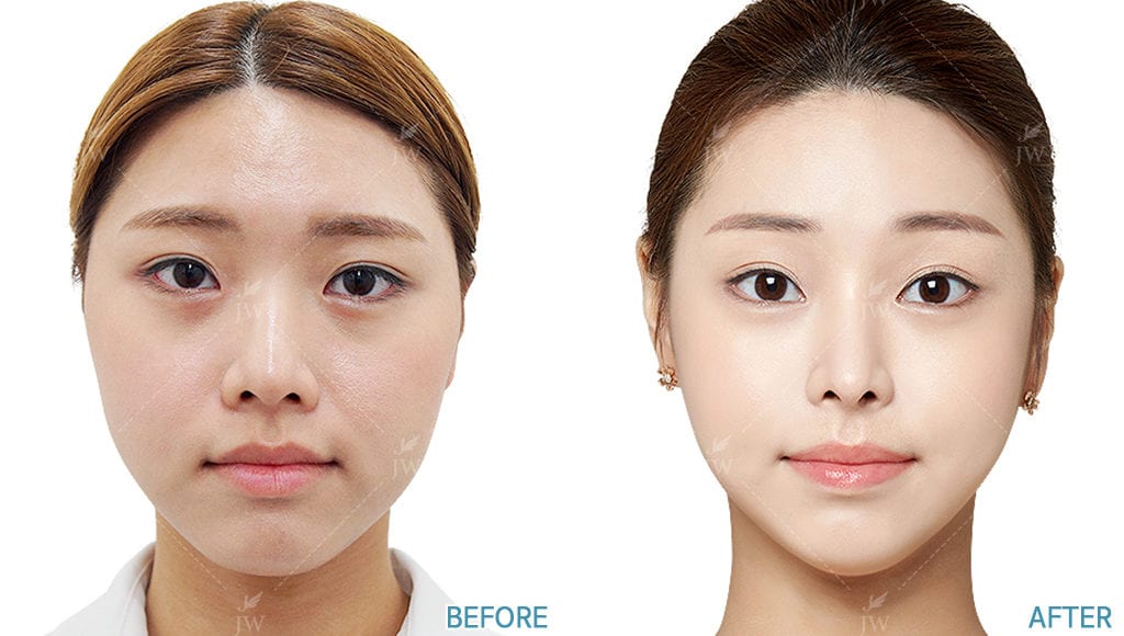 健康・医学 facial bone contouring surgery Current Practices for Esthetic Facial Bone Contouring