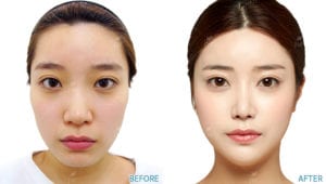 Before After Face Contouring In Korea