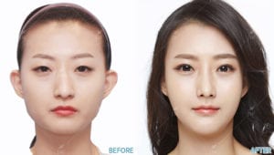 Before After Face Contouring In Korea
