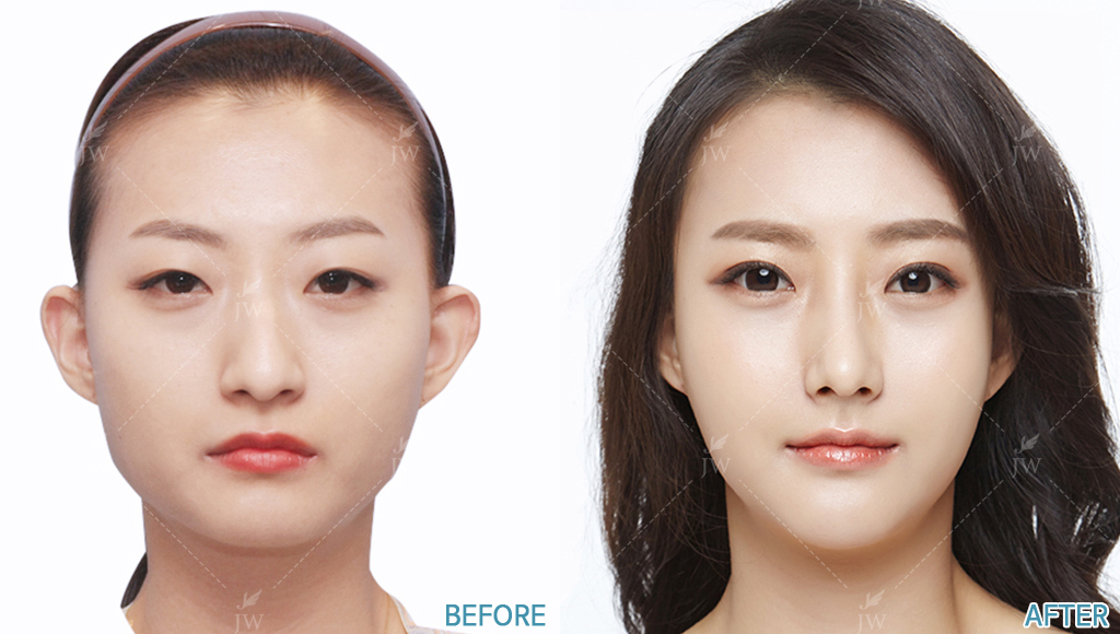 Before After Face Contouring In Korea