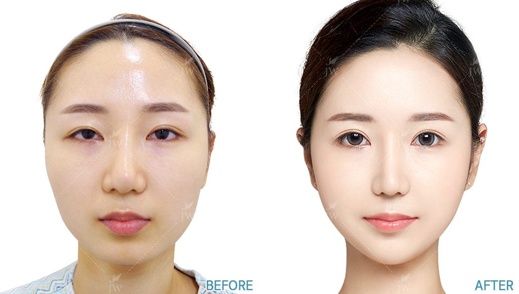 健康・医学 facial bone contouring surgery 51CKJdV5tpL._UF1000,1000_QL80_.jpg
