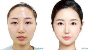 Before After Face Contouring In Korea