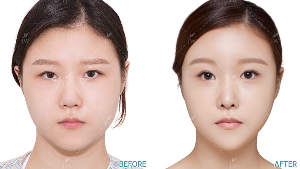 健康・医学 facial bone contouring surgery Facial Bone Contouring - Cheekbone Reduction, Jaw Reduction