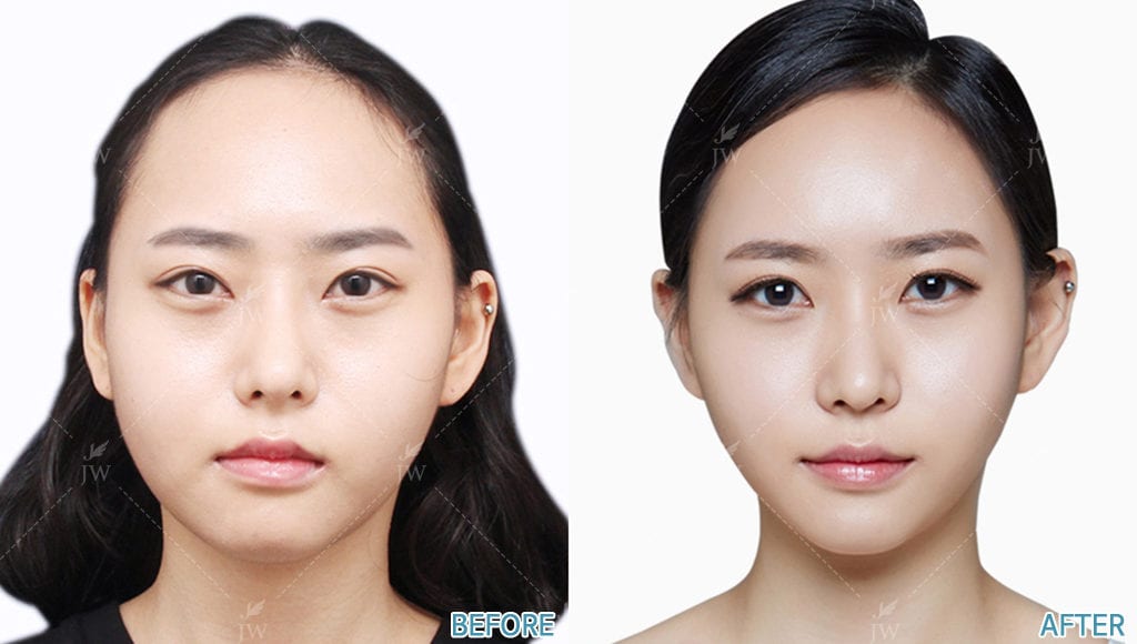 健康・医学 Facial Bone Contouring Surgery Current Practices for Esthetic Facial Bone Contouring