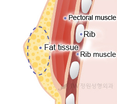 gynecomastia-breast-reduction-for-men-korea-1
