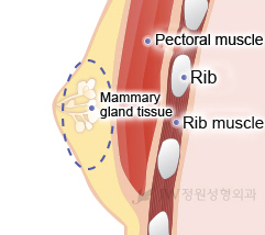 gynecomastia-breast-reduction-for-men-korea-2