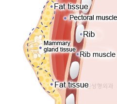 gynecomastia-breast-reduction-for-men-korea-3