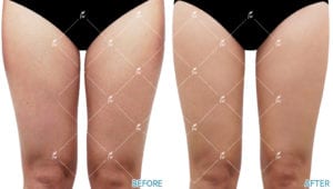 plastic surgery body contouring korea
