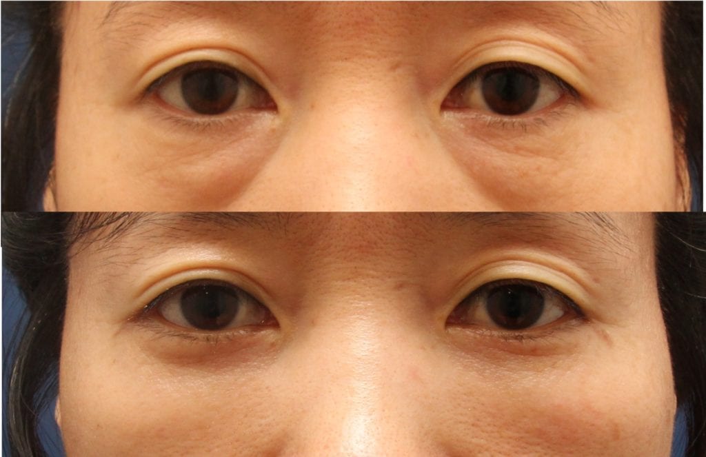 undereye surgery korea