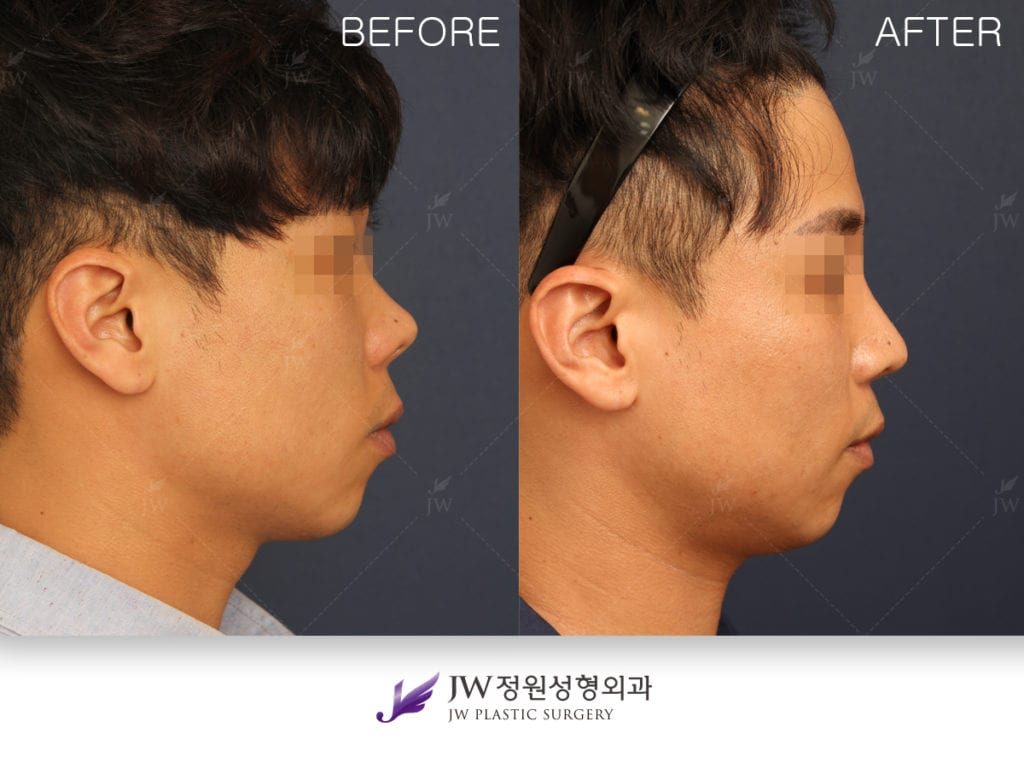 How to prevent warping of rib cartilage used for nasal bridge augmentation  - JW Plastic Surgery