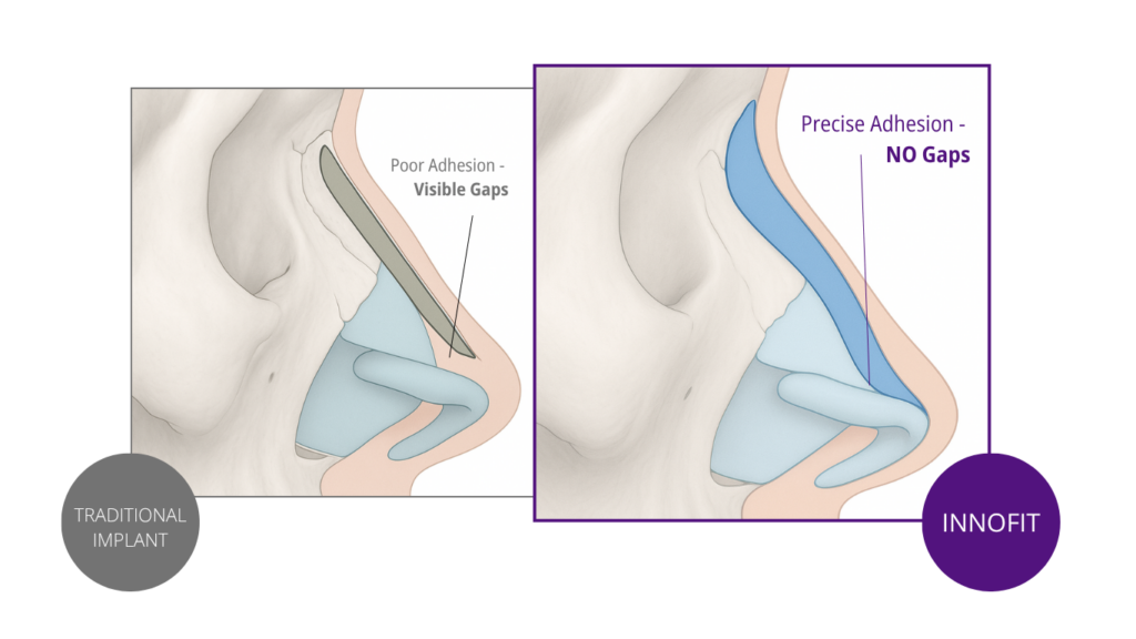 this is innofit implanbt nasal implant asian rhinoplasty in comparison to a normal implant