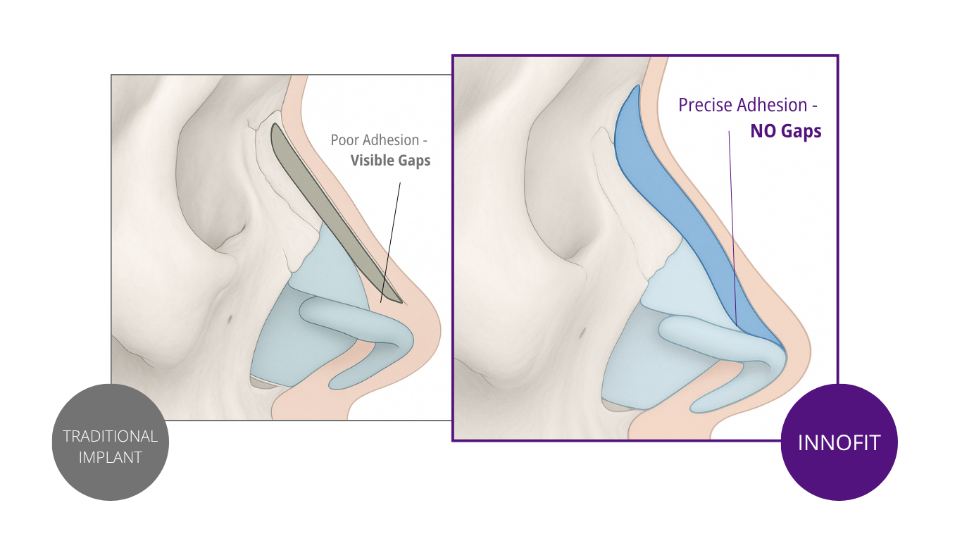 this is innofit implanbt nasal implant asian rhinoplasty in comparison to a normal implant
