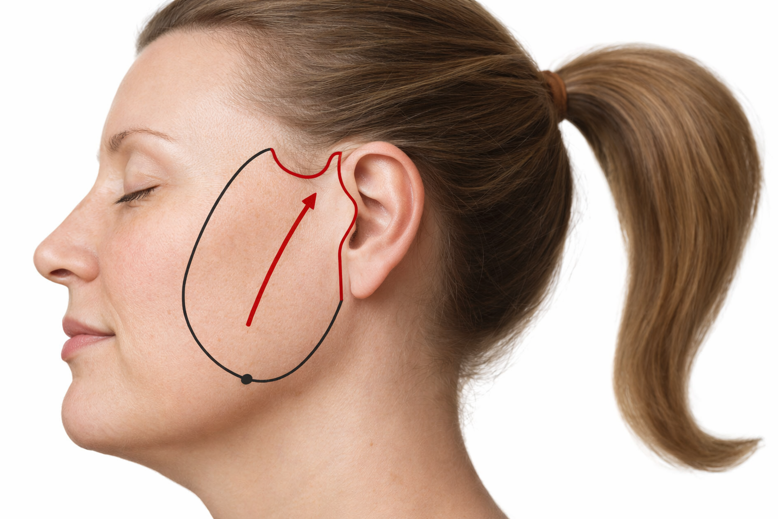 Minimal Access Cranial Suspension (MACS) lift: The incision (red) and skin undermining (black) in the MACS lift.