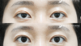 non incision ptosis correctiopn before and after photo