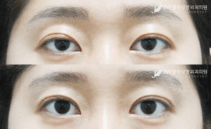 non incision ptosis correctiopn before and after photo
