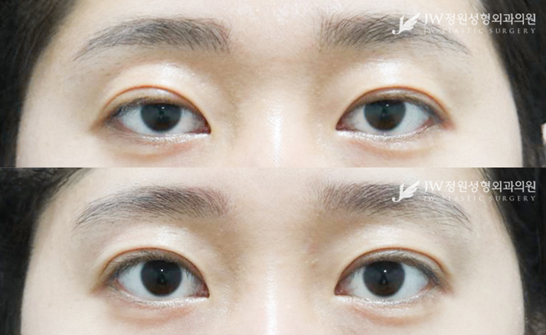 non incision ptosis correctiopn before and after photo