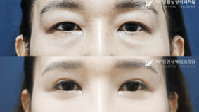 Lower blepharoplasty and upper blepharoplasty before and after photo