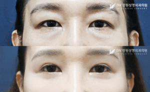 Lower blepharoplasty and upper blepharoplasty before and after photo