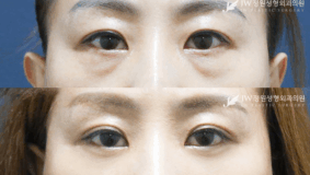 Lower blepharoplasty and upper blepharoplasty before and after photo