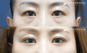 Lower blepharoplasty and upper blepharoplasty before and after photo