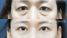 Lower blepharoplasty and upper blepharoplasty before and after photo