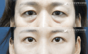 Lower blepharoplasty and upper blepharoplasty before and after photo