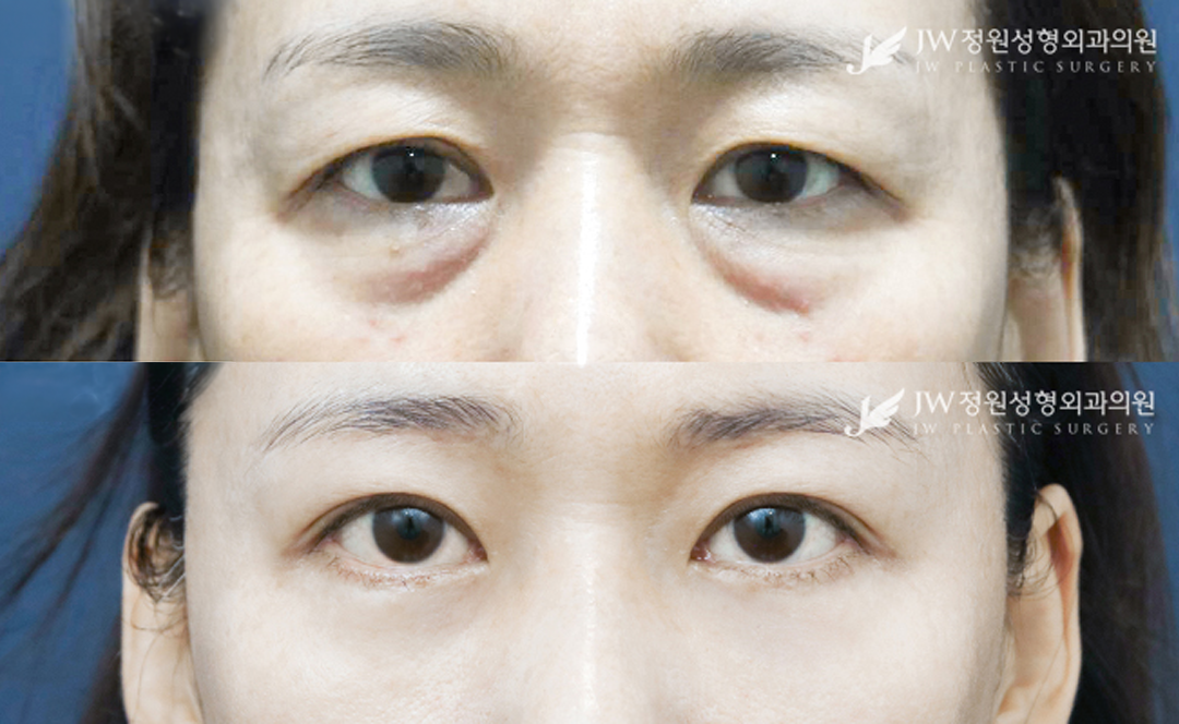 Lower blepharoplasty and upper blepharoplasty before and after photo