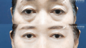 Lower blepharoplasty and upper blepharoplasty before and after photo