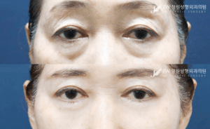 Lower blepharoplasty and upper blepharoplasty before and after photo