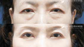 Lower blepharoplasty and uper blepharoplasty before and after photo