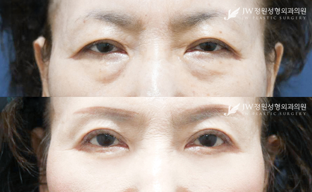Lower blepharoplasty and uper blepharoplasty before and after photo