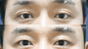 Ptosis correction before and after photo