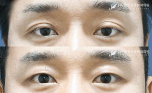 Ptosis correction before and after photo