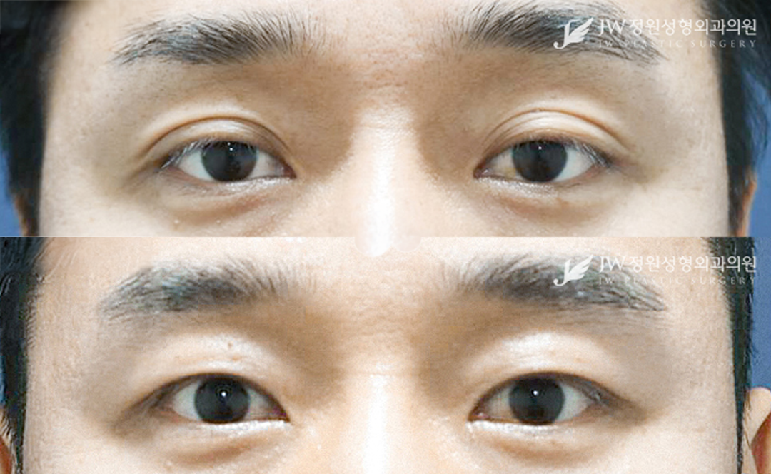 Ptosis correction before and after photo