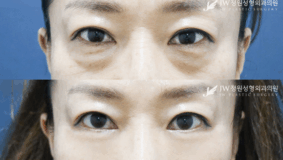 Lower blepharoplasty before and after photo