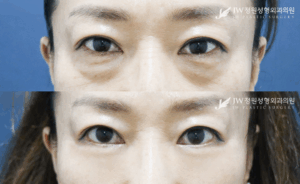 Lower blepharoplasty before and after photo